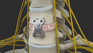 Anterior Cervical Discectomy with Fusion (ACDF)