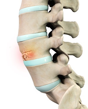 Compression Fractures