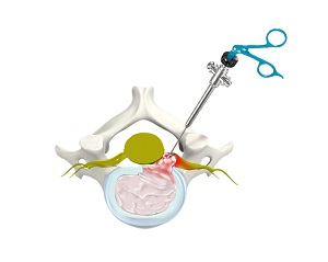 Thoracic Discectomy