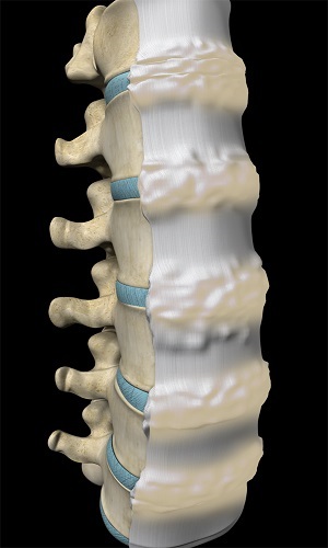 Dish (Diffuse Idiopathic Skeletal Hyperostosis)