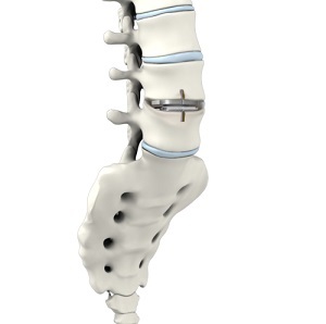 Lumbar Artificial Disc Replacements