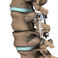 Lumbar Fusions