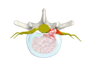 Herniated Disc (Lumbar)