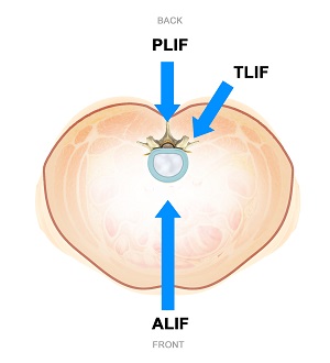 Minimally Invasive Lumbar Fusions