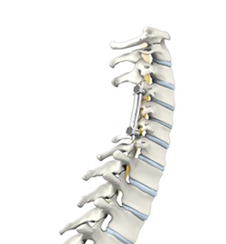 Multilevel Posterior Cervical Laminectomy & Fusion