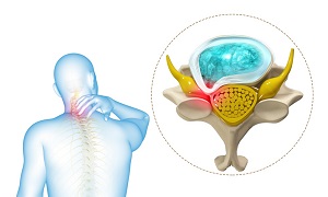 Myelopathy