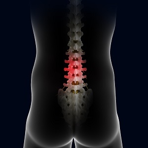 Possible Complications of Spinal Surgeries