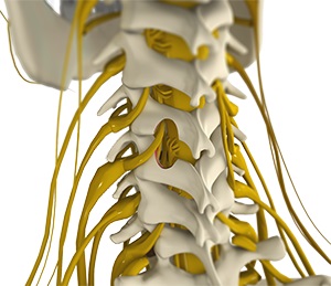 Posterior Cervical Microforaminotomy
