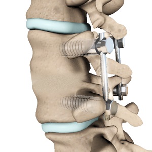 Posterior Lumbar Fusions