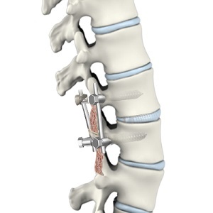 Posterior Lumbar Interbody Fusion Surgery