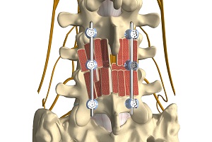 Posterolateral Lumbar Fusion