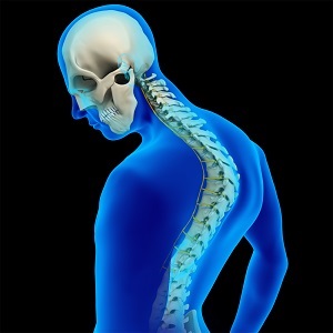 Scheuermann's Kyphosis