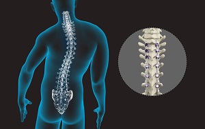 Spinal Deformity Surgery