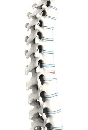Thoracic Vertebroplasty