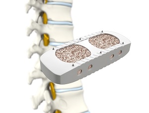 X-LIF Extreme Lateral Interbody Fusion