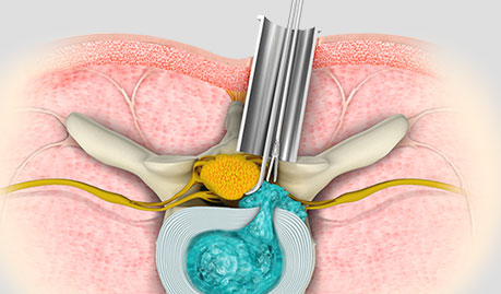 Minimally Invasive Spine Surgery